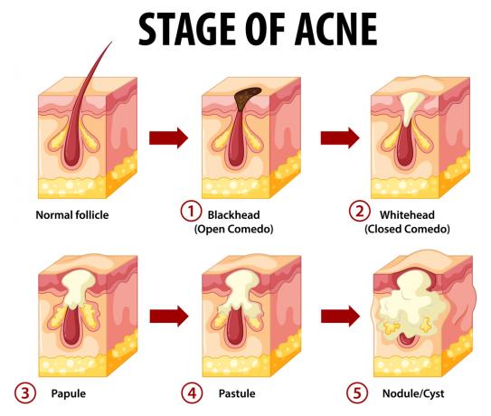 Brufoli del cuoio capelluto e sintomi dell'acne, ragioni, rimedi