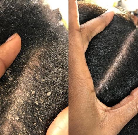 Los mejores tratamientos de peluquería para el cuero cabelludo