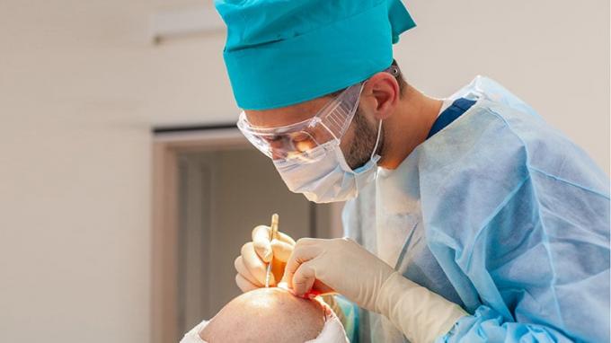 Liečba plešatosti. Transplantácia vlasov. Chirurgovia na operačnom sále vykonávajú chirurgickú transplantáciu vlasov. Chirurgická technika, ktorá premiestňuje vlasové folikuly z časti hlavy.