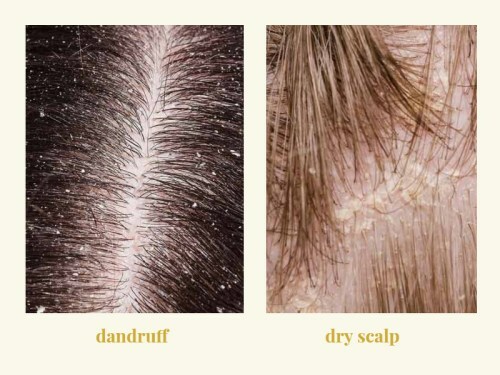 Hilse vs kuiva päänahka