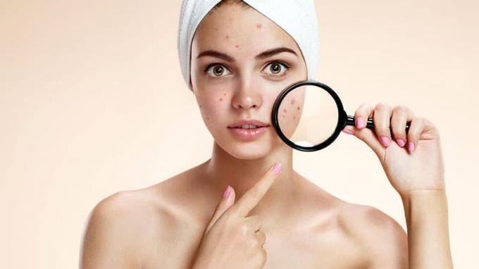 ¿Qué causa el acné?
